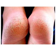 Что вы должны знать об удалении сухой кожи с ног.